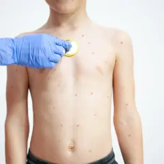 Ospa wietrzna: Kiedy dziecko ze strupami bezpiecznie wróci do przedszkola?