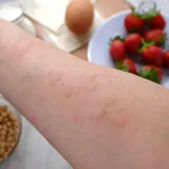 Alergia u dziecka: Szybka ulga w domu i kiedy do lekarza?