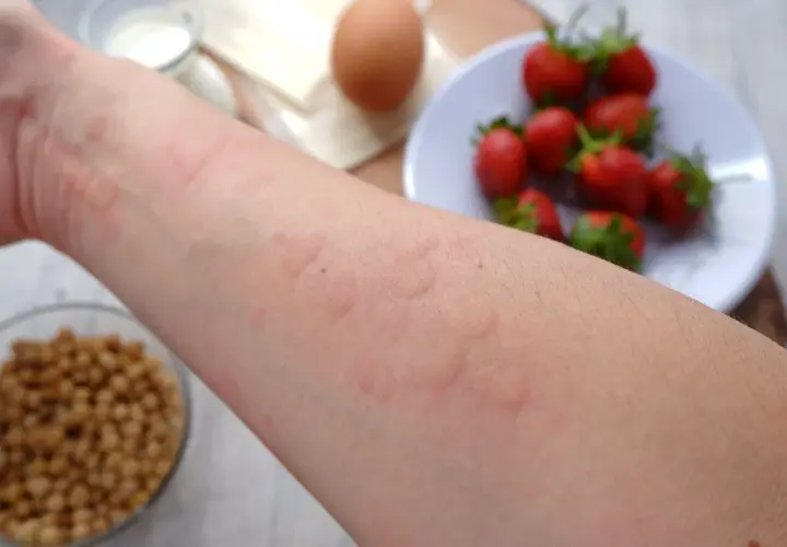 Alergia u dziecka: Szybka ulga w domu i kiedy do lekarza?