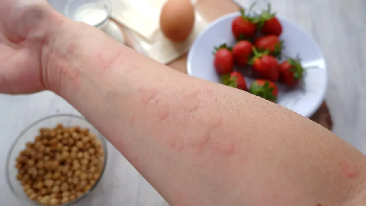Alergia u dziecka: Szybka ulga w domu i kiedy do lekarza?