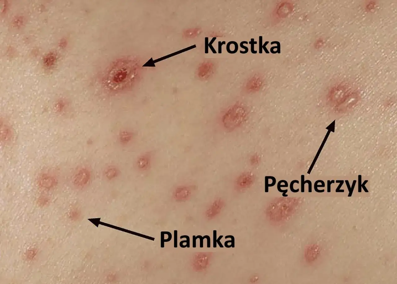 Ospa wietrzna etapy wysypki pęcherzyki strupki